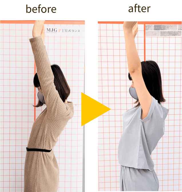 20代女性の改善例。両腕の挙上が改善。